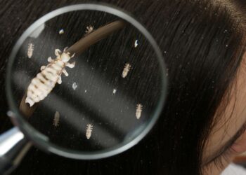 از کجا بفهمیم شپش درمان شده