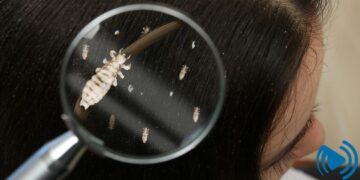 از کجا بفهمیم شپش درمان شده