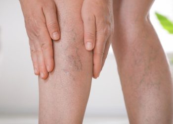 چه چیزهایی باعث واریس میشود