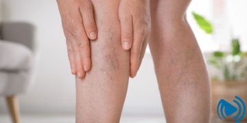 چه چیزهایی باعث واریس میشود