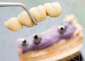 آیا ایمپلنت باعث سرطان می‌شود