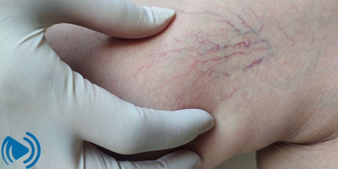 واریس خفیف و مدیریت آن