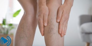 برای جلوگیری از واریس پا چه کنیم