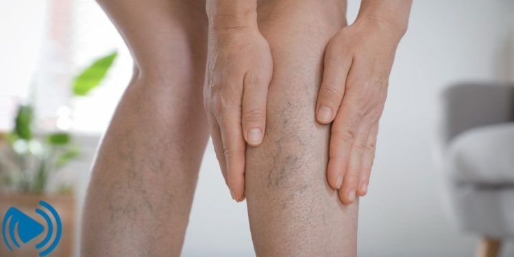 برای جلوگیری از واریس پا چه کنیم