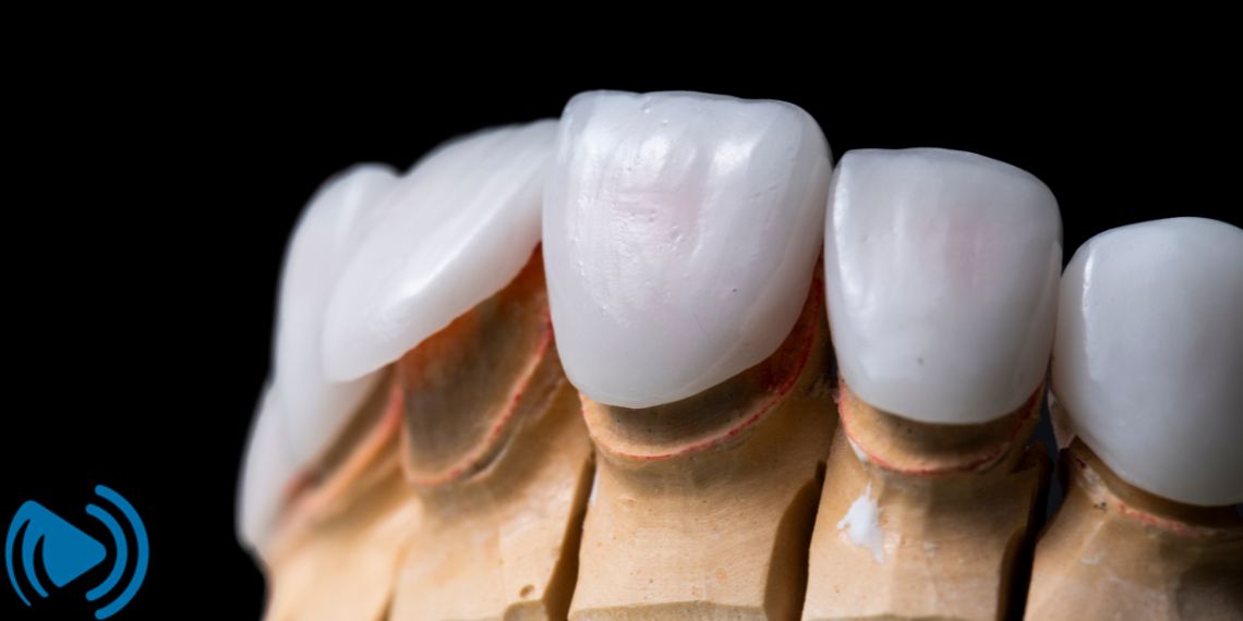 مزایای لمینت دندان